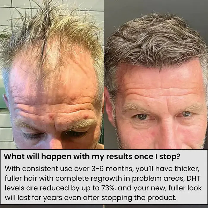 Alpha Infuse™ Hair Regrowth System