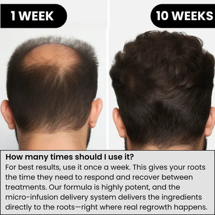 Alpha Infuse™ Hair Regrowth System